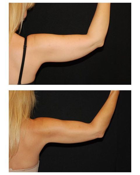 results of coolsculpting