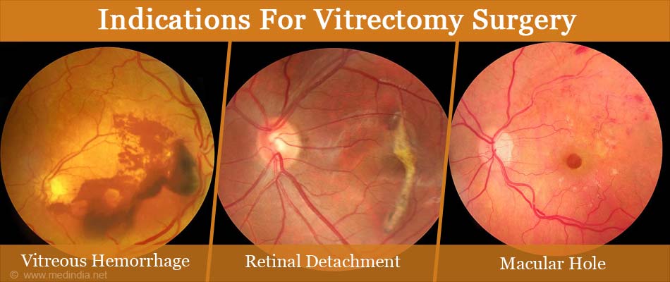 indications for vitrectomy surgery